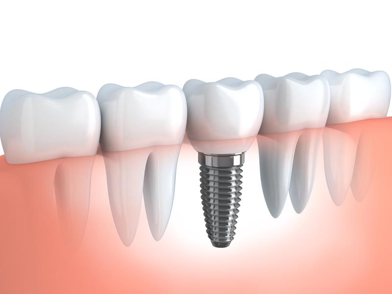Dental Implants  Webster, NY 