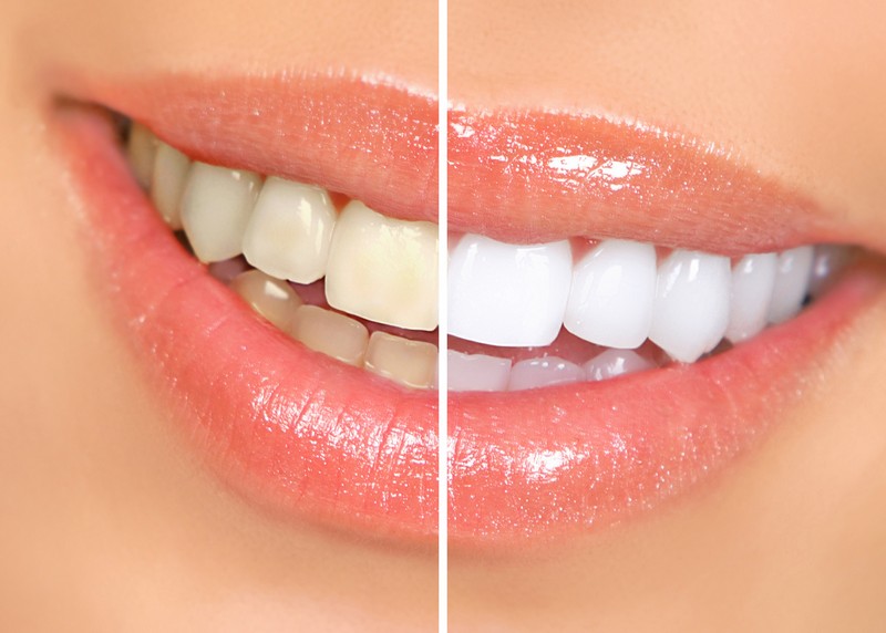 Teeth Whitening  Webster, NY 